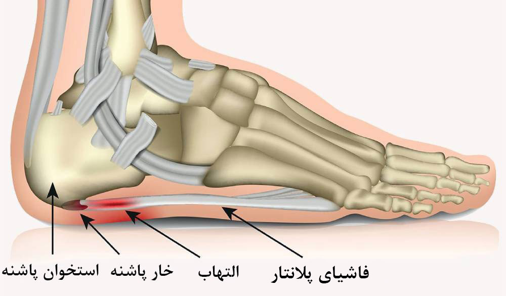 علائم بیماری خار پاشنه