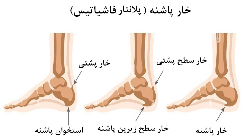 انواع خار پاشنه