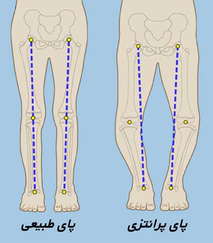 درمان پای پرانتزی Genu Varum