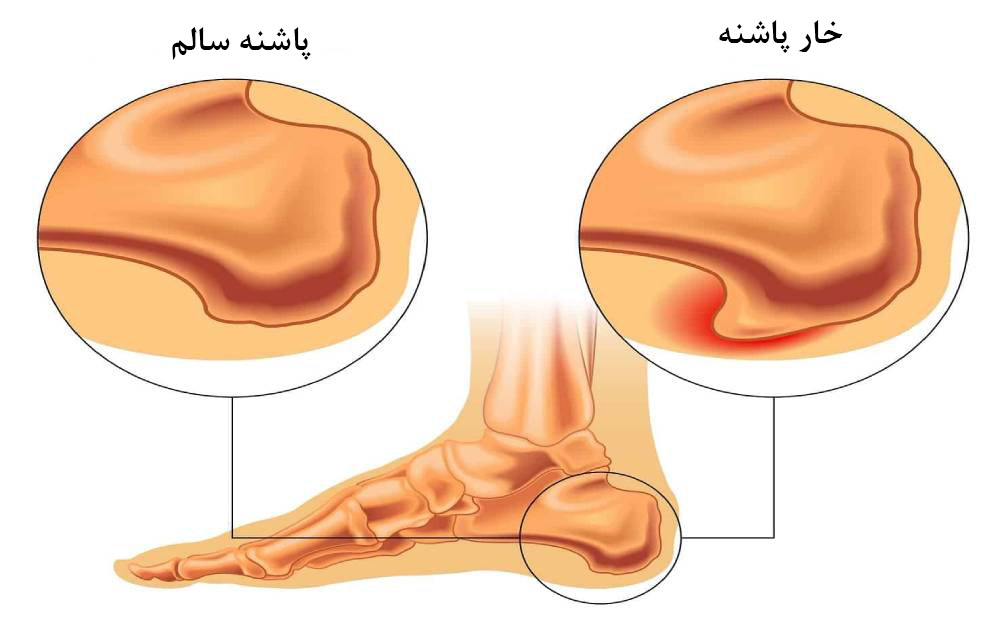 بیماری خار پاشنه