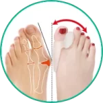 کفش مناسب هالوکس والگوس